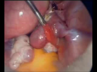 laparoscopic surgery for ectopic pregnancy