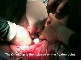 vacuum extraction for caesarean section