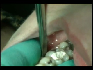 removal of a tooth